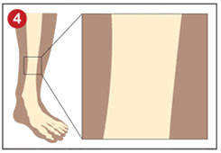 Fracture putty for traumatic bone regeneration