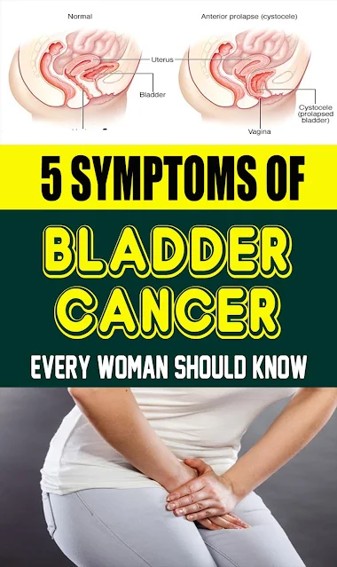 5 Symptoms Of Bladder Cancer Every Woman Should Know