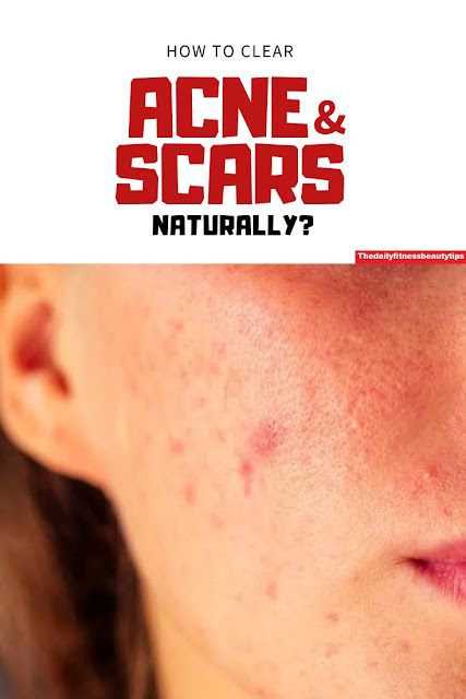 Acne-scars-removal-face-mask