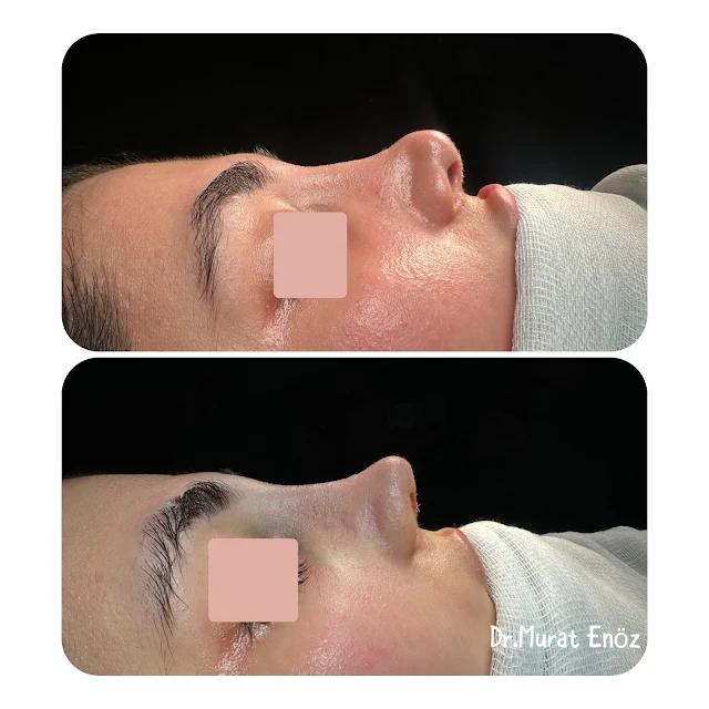 Polly-beak nose deformity,Pollybeak Deformity,Parrot Beak Deformity,Polly beak deformity,revision rhinoplasty,