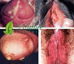 Gonore Kencing nanah sipilis Gonore Kencing nanah sipilis