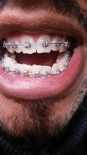 this is my bite before surgery, needs a lot of work 