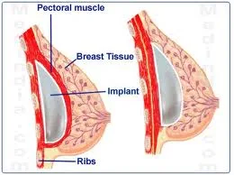 Breast augmentation. Breast augmentation, breast augmentation cost, information on breast augmentation