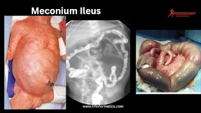 Meconium Ileus