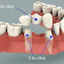 Trồng răng giả cố định có ảnh hưởng gì không?