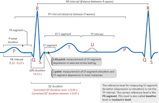   ekg คือ, ekg ผิดปกติ, ekg 12 lead ปกติ, normal sinus rhythm คือ, basic ekg, p wave คือ, การติด ekg monitor, กราฟคลื่นหัวใจผิดปกติ, ekg ย่อมาจาก