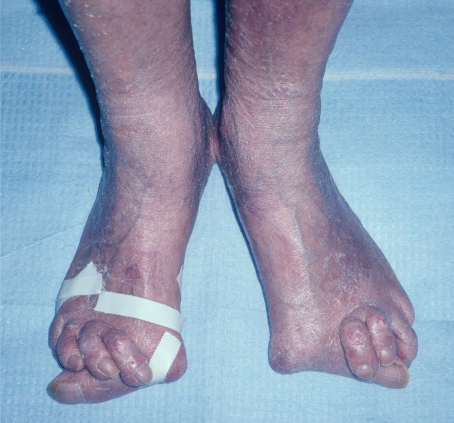 Download this Deformities The Feet... picture