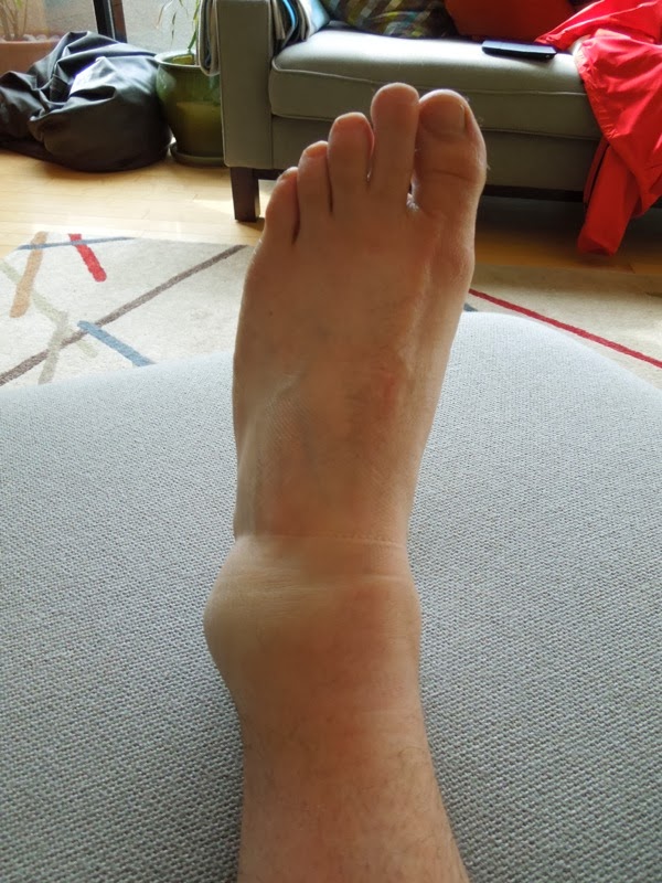 Badly sprained ankle