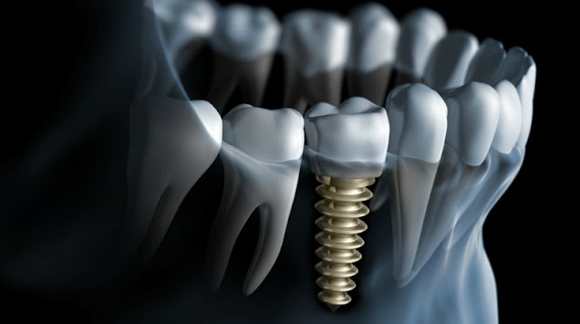 Osseointegration Implants