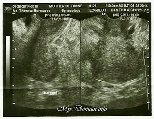 "adenomyosis ultrasound - simplymarrimye"