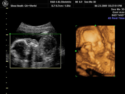 Black And White 4d Ultrasound. 3D/4D Ultrasound