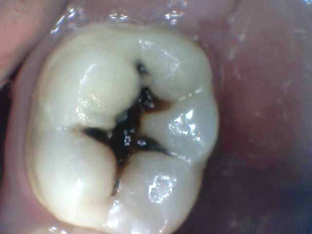 cavities in molars. area on one of his molars.