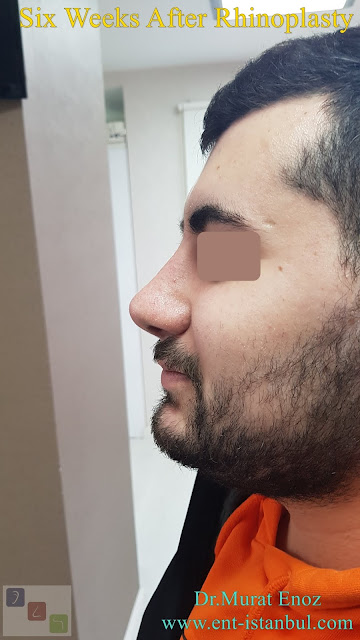 Male nose job Turkey. Nose aesthetic surgery for men,Rhinoplasty in Men Istanbul,