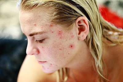 Acne - a struggle for male and female