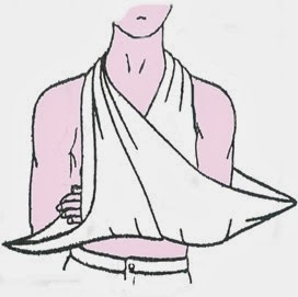 bandage echarpe