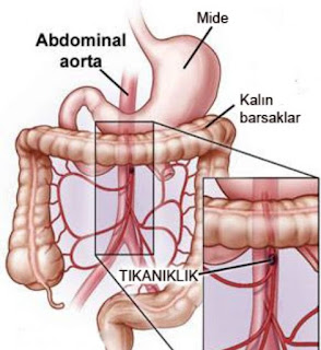Bağırsak Tıkanıklıkları