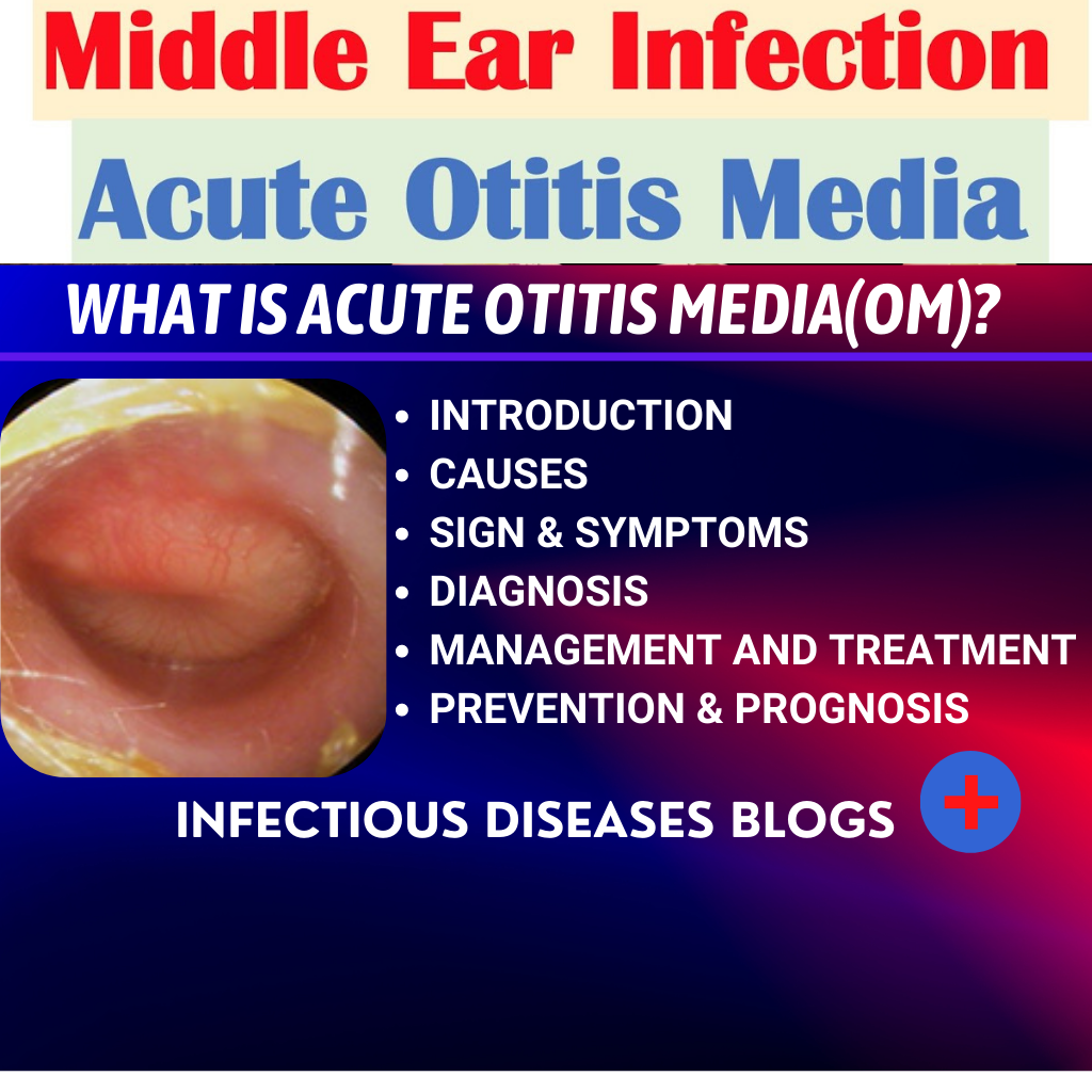 What is Acute Otitis media(AOM)?