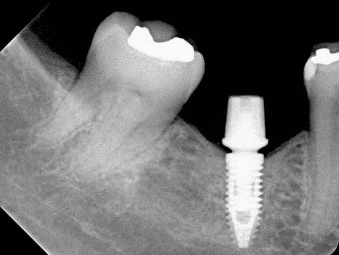 PERIODONTIA: Estudo avalia incidência de perdas dentárias e implantares