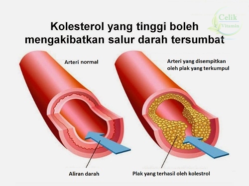 JUS HERBA JANTUNG Rawatan Alternatif untuk Salur Jantung 