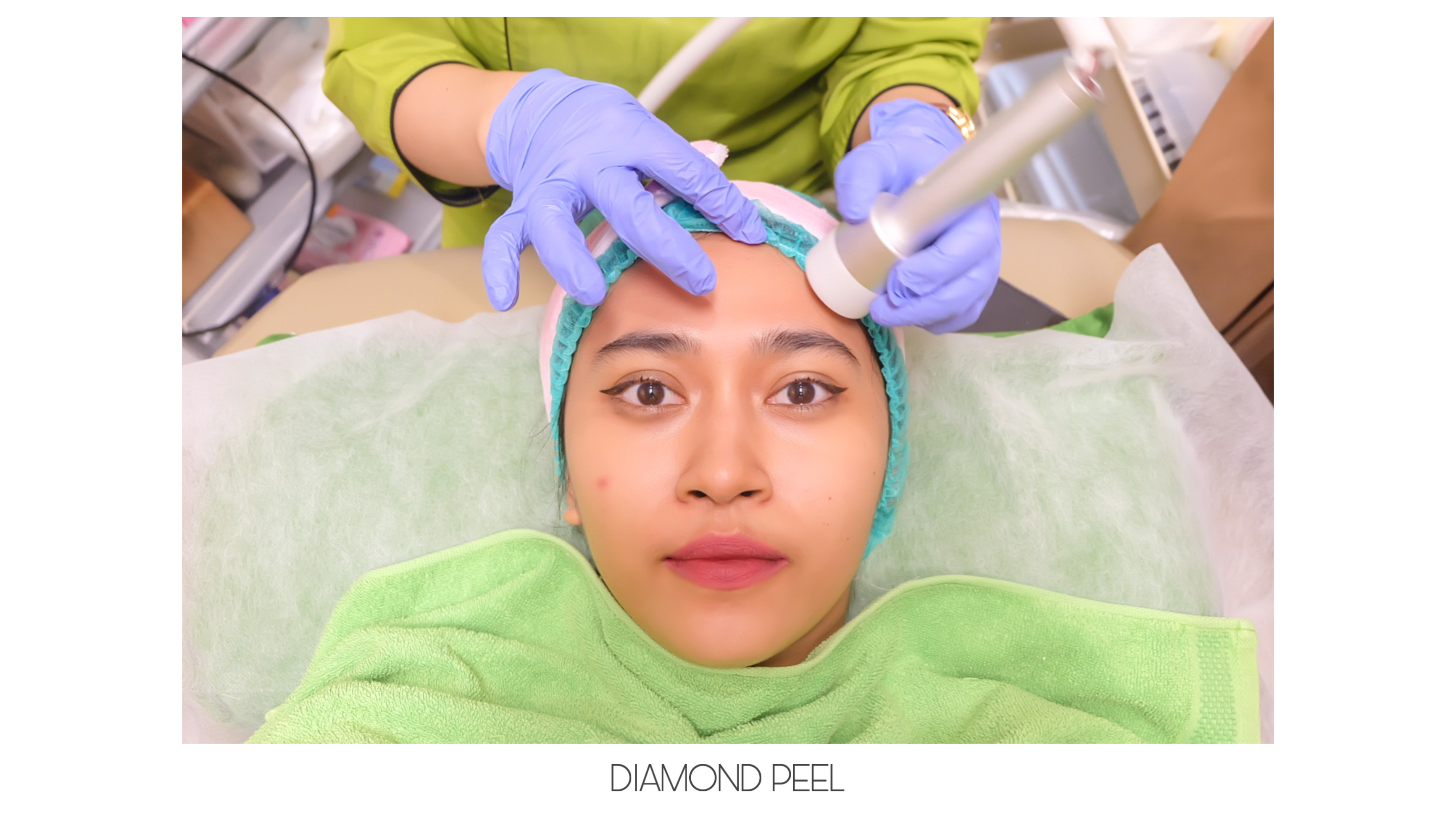 [Review] Treatement Diamond Peel dan Photo Facial Glow di ZAP Clinic