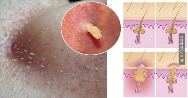 Pakai Pasta Gigi, Komedo Bersih Total, Begini Caranya 