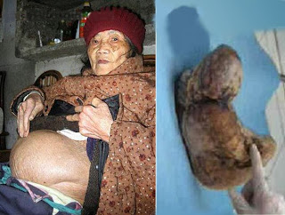 old women pregnant dead baby