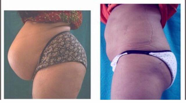 Abdominoplasty In Delhi