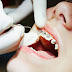 Quy trình niềng răng lệch khớp cắn 5 bước tiêu chuẩn