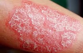 Cara Efektip Mengobati Penyakit Psoriasis Dengan Obat Herbal alami