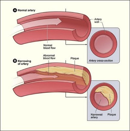 atherioclerosis