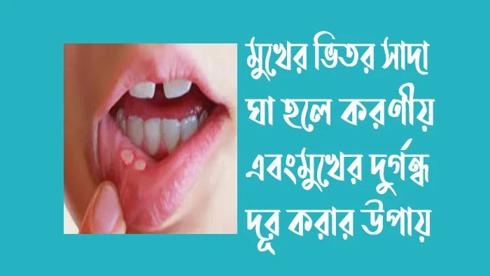 মুখের ভিতর সাদা ঘা হলে করণীয় - মুখের দুর্গন্ধ দূর করার উপায়