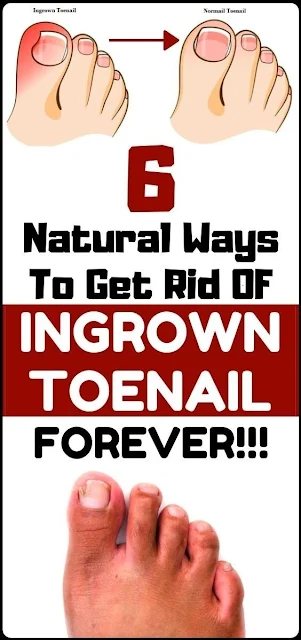 Solve Your Ingrown Toenail With These 6 Natural & Homemade Remedies