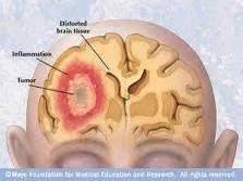 Brain Tumor Symptoms