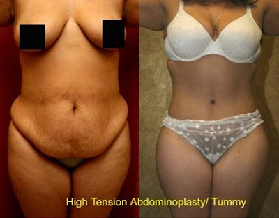 Abdominoplasty Before And After. (Abdominoplasty) Images