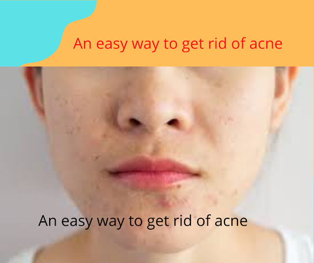 An easy way to get rid of acne