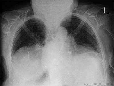 Chest X-rays of the Kyphotic Chest X-rays of the Kyphotic