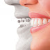 Làm gì để hạn chế đau răng khi chỉnh nha?