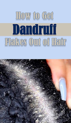 Here is a picture of a woman’s scalp with flaky dandruff.