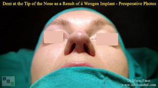 Breathe Implant à Wengen,4. revision nose job, Dent After Rhinoplasty, Complicated 4th Revision Rhinoplasty, Nasal contour irregularities, Postoperative dent issues, Revision rhinoplasty challenges, Rhinoplasty side effects, Nasal structural integrity,