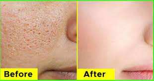 Open pores treatment at home