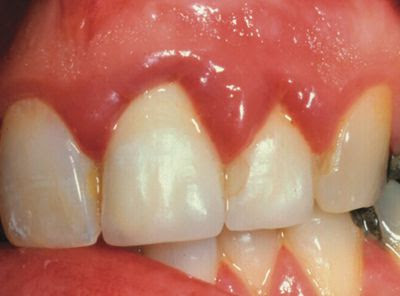 Phương pháp làm răng sứ mà không viêm lợi
