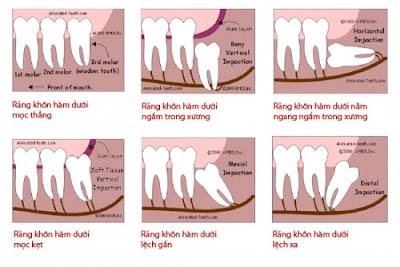 Vì sao nên nhổ răng số 8 mọc ngầm mọc lệch?