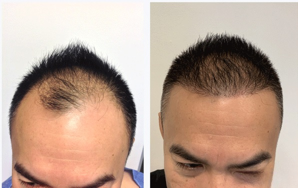 Uomo di 33 anni dopo trapianto di capelli con metodo DHI a Tirana, prima e dopo 7 mesi