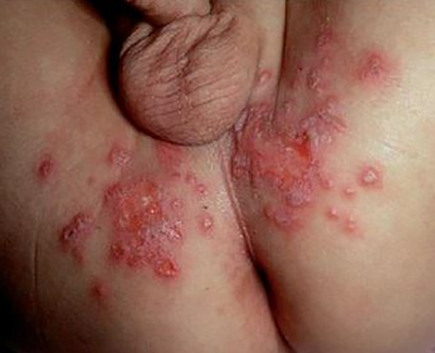 obat herpes simplex