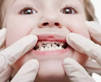 Penyebab Gigi Hitam pada Anak dan Cara Mengatasinya