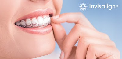 Quy trình niềng răng invisalign như thế nào? 1