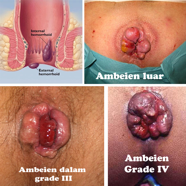 pengobatan Hemorrhoid