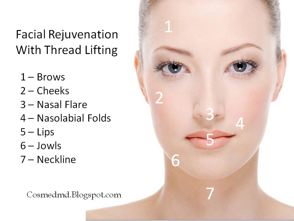 Thread Lifts - The No-Surgery Face Lifting Alternative ...