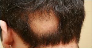 The-Normal-Hair-Growth-of-Alopecia-Hair-Loss