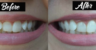 Whiten Your Yellow Teeth in Less Than 2 Minutes